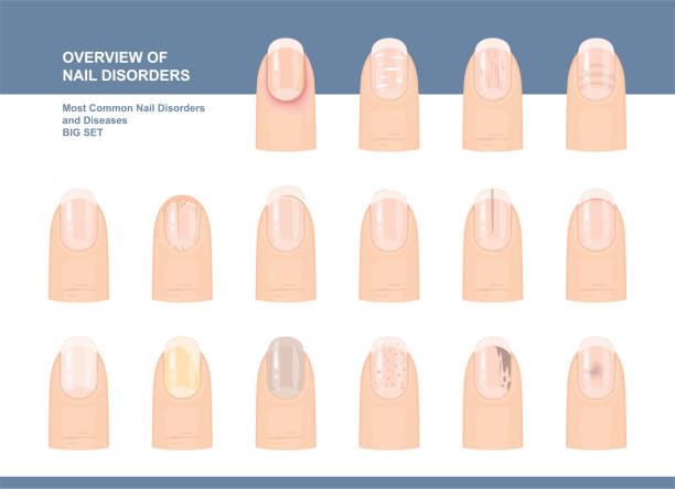 Most Common Nail Disorders and Diseases. Big set. Vector illustration Most Common Nail Disorders and Diseases. Big set. Vector illustration mycology stock illustrations