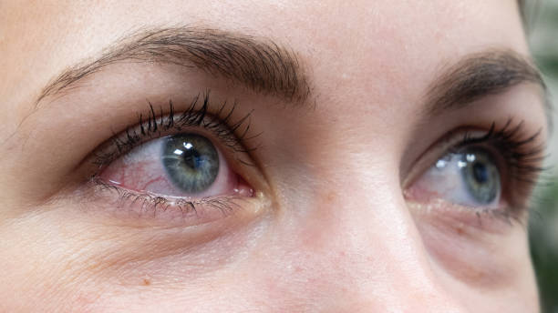 голубые глаза двух женщин с покраснеными белками от аллергического конъюнктивита - conjunctiva стоковые фото и изображения