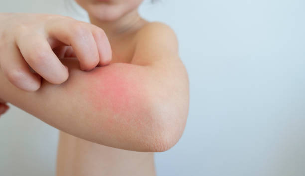 Itch Little girl is scratching her arm. bug bite photos stock pictures, royalty-free photos & images