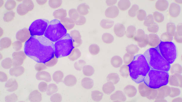 혈액 얼룩 cbc에 백혈병 파테인에 있는 돌풍 세포. - leukemia pathologist blood hematologist 뉴스 사진 이미지