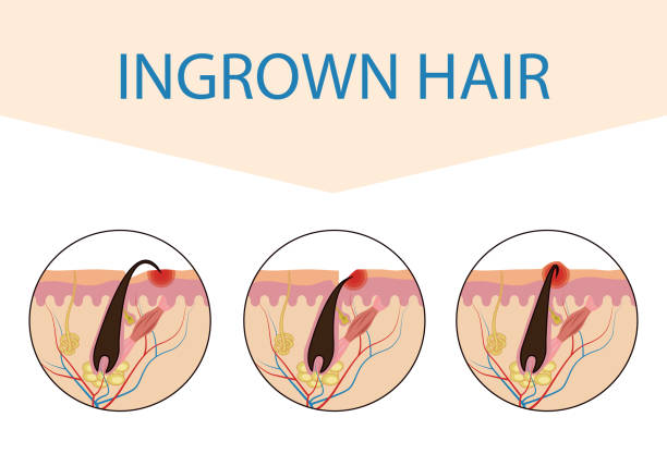 Varieties Of Ingrown Hair Medical Scheme Of Hair Ingrowth Vector  Illustration Isolated On White Background For Design And Internet Stock  Illustration - Download Image Now - iStock