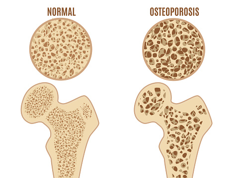 Cartoon Color Osteoporosis Bones Ad Poster Card Skeletal Health Concept Flat Design. Vector illustration of Spongy Texture Bone