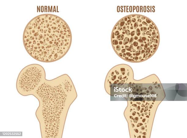 Cartoon Color Osteoporosis Bones Ad Poster Card Vector Stock Illustration -  Download Image Now - iStock
