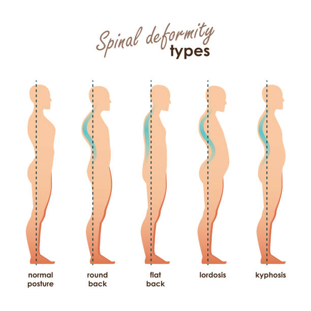 Spinal deformity types. Diseases of the spine.Lordosis, kyphosis, round back, flat back. Vector human silhouettes Spinal deformity types. Diseases of the spine.Lordosis, kyphosis, round back, flat back. Vector human silhouettes for your design deformed stock illustrations