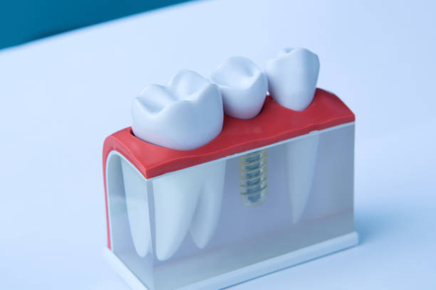 istock Dentists tooth plastic model with screw implant for teaching, learning and patients in dental office showing teeth and gums. 1202799914