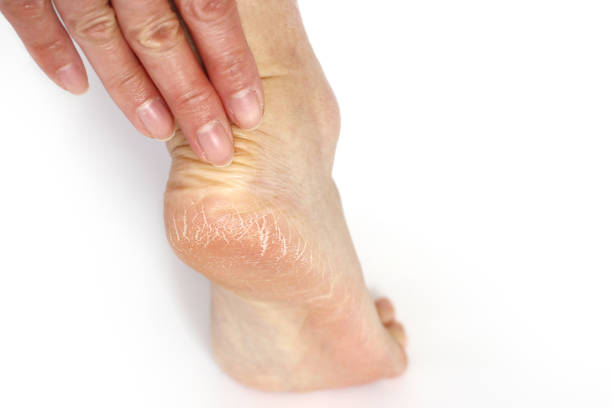 istock Cracked heel : body parts 1202888943
