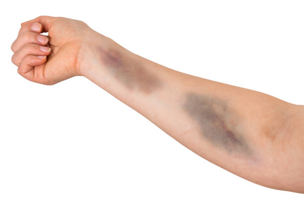 Large bruise on human arm. Domestic violence. Large bruise on human arm. Domestic violence concept. bruise stock pictures, royalty-free photos & images