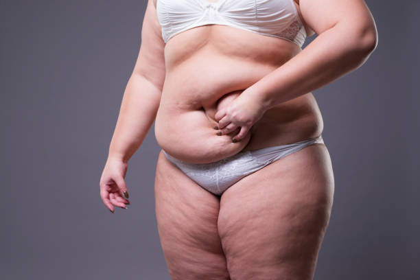 tummy tuck, schlaffe haut auf einem fetten bauch, plastische chirurgie konzept - torso female hip human skin stock-fotos und bilder