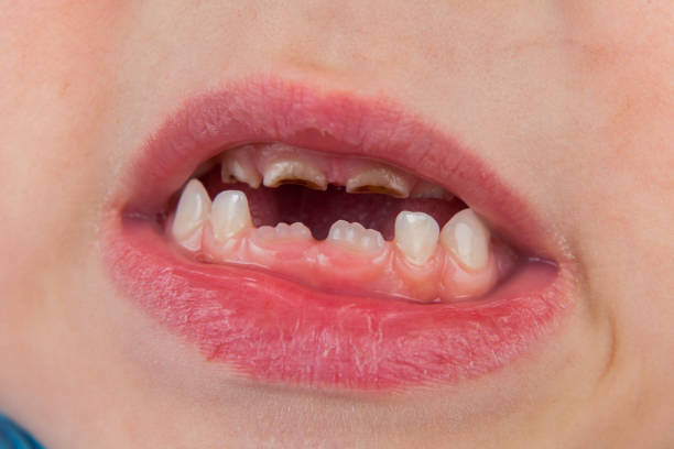 istock Crooked permanent teeth grow in a boy aged 6 years 1203324622