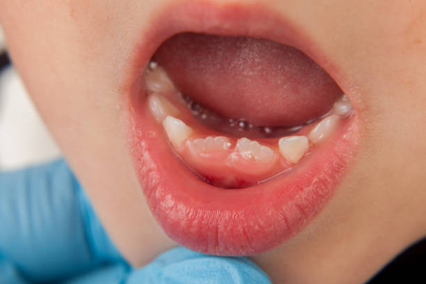 istock Crooked permanent teeth grow in a boy aged 6 years 1203324664