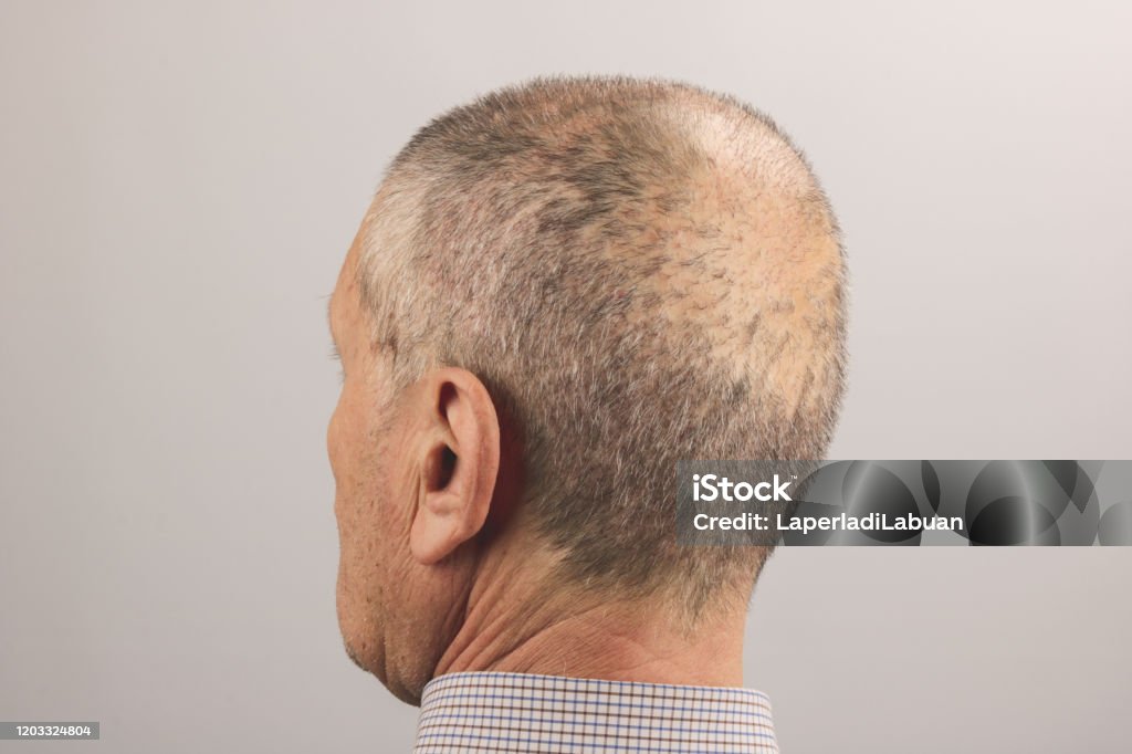 View Of A Man Head With Hair Transplant Surgery Area Stock Photo - Download  Image Now - iStock