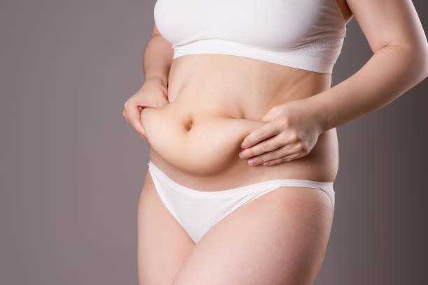 tummy tuck, flabby skin on a belly, plastic surgery concept - overweight women body abdomen imagens e fotografias de stock