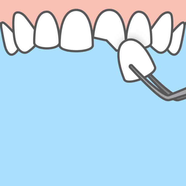 Blank banner Upper Veneer tooth illustration vector on blue background. Dental concept. Blank banner Upper Veneer tooth illustration vector on blue background. Dental concept. peeling off stock illustrations