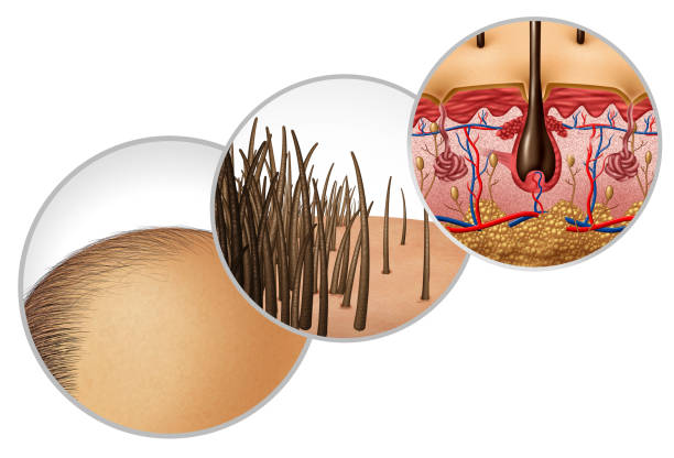 istock Hair Loss Diagram 1203692381