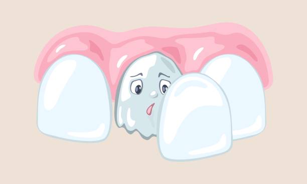 Bad tooth is among healthy teeth. Installation of veneer, implant, whitening procedure Bad tooth is among healthy teeth. Installation of veneer, implant, whitening procedure. Painless solution of dental problems. Vector cartoon illustration isolated on white background. cute cartoon dental implants stock illustrations