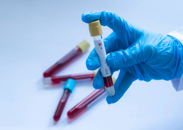 Hiv Test, Hiv Positive stock photo