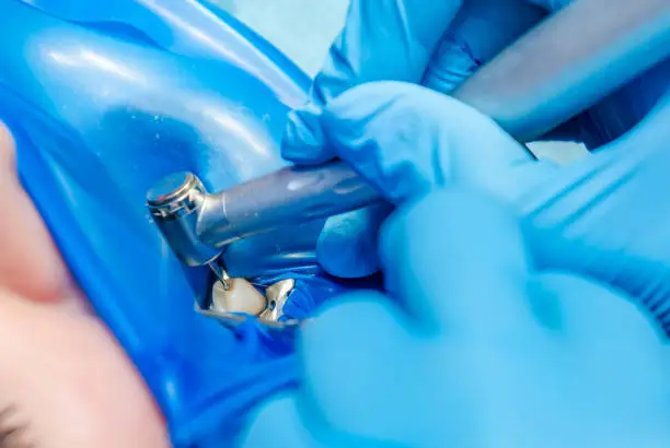 Photo of Tooth treatment in dentistry. The mouth is covered with a blue rubber pad