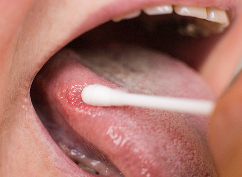 Tomando un frotis por una enfermedad en la lengua de una mujer. Concepto de investigación de la enfermedad de la lengua de gingivitis y gingivitis, photo