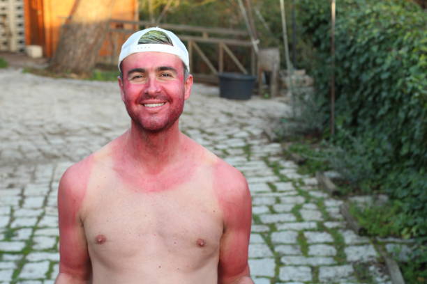 istock Sunburned young man with extreme tan lines 1203803598