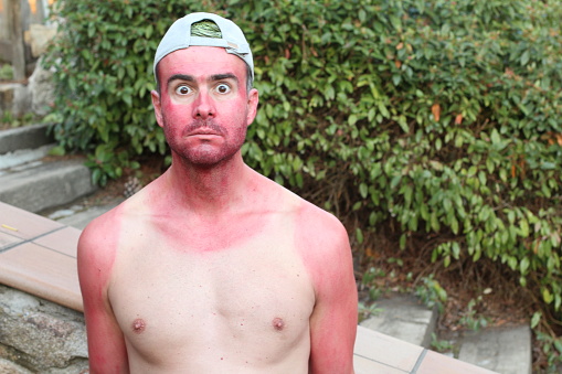 Sunburned young man with extreme tan lines.