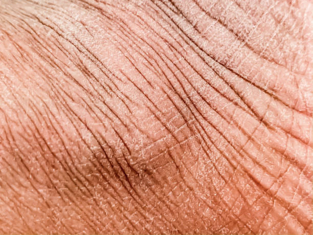 Dry Skin During Wintertime