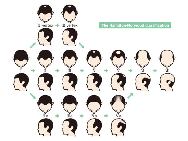 kuvapankkikuvitukset aiheesta tiedot hiustenlähtövaiheista ja kaljuuntumisen tyypeistä, jotka on kuvattu miehen päässä. - receding hairline