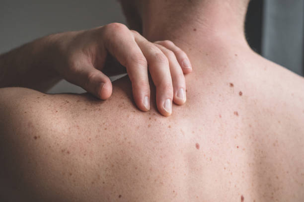 sprawdzanie łagodnych moli. zbliżenie szczegółów na gołej skórze na człowieku z powrotem z rozrzuconymi moliami i piegami - melanoma mole human skin dermatology zdjęcia i obrazy z banku zdjęć