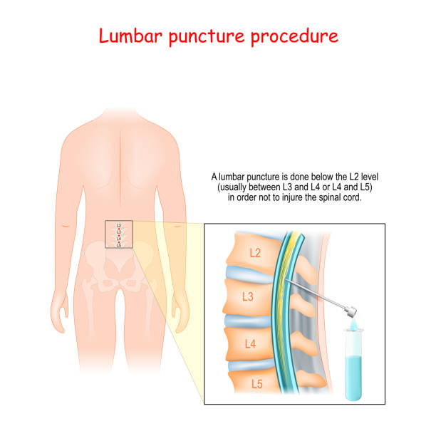 Spinal Tap Procedure Detailed Diagram Of Lumbar Puncture Human Silhouette With Vertebral Column Stock Illustration - Download Image Now - iStock Spinal Tap Procedure Detailed Diagram Of Lumbar Puncture Human Silhouette With Vertebral Column Stock Illustration - Download Image Now - iStock