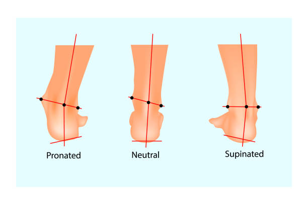 Vector illustration of the normal human foot and the foot with pronation and supination. Foot Biomechanics. Orthodic. Vector illustration of the normal human foot and the foot with pronation and supination. Foot Biomechanics. Orthodic. pes planus stock illustrations