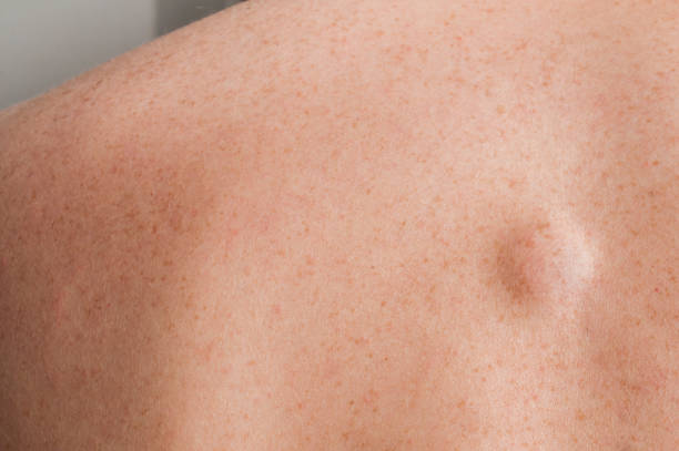 istock Small lipoma on the back of caucasian man 1204013640