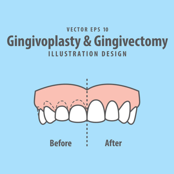 Compare upper teeth Gingivoplasty & Gingivectomy surgery before and after electrosurgery cut gum off illustration vector on blue background. Dental concept. Compare upper teeth Gingivoplasty & Gingivectomy surgery before and after electrosurgery cut gum off illustration vector on blue background. Dental concept. gingivoplasty stock illustrations