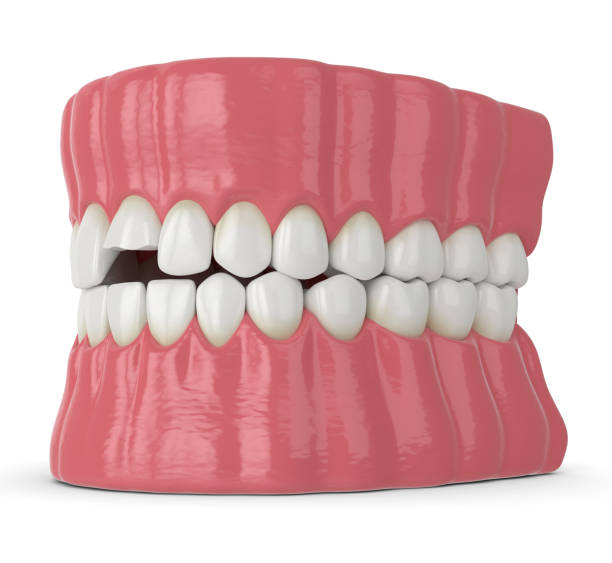 istock 3d render of jaw with broken incisor upper tooth 1204178197