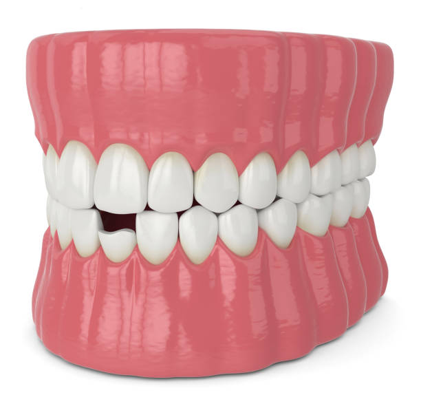 istock 3d render of jaw with broken incisor lower tooth 1204178221