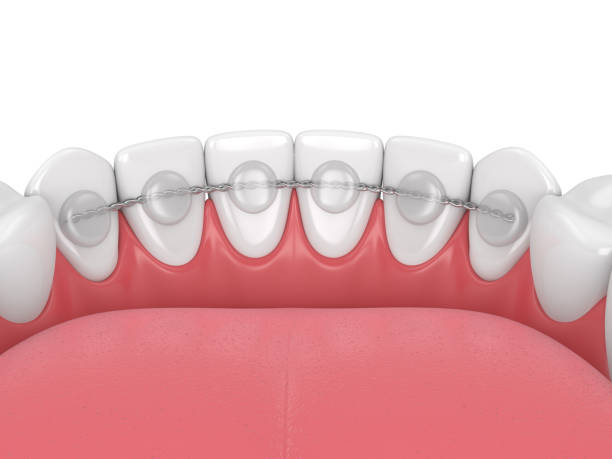 istock 3d render of dental bonded retainer on lower jaw 1204178241