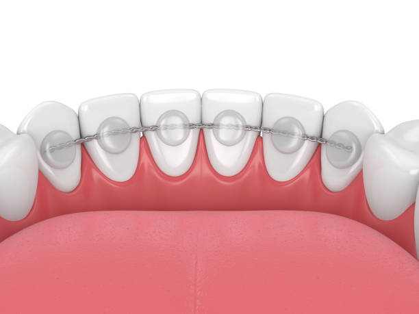3d render of dental bonded retainer on lower jaw stock photo