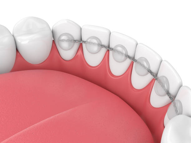 3d render of dental bonded retainer on lower jaw stock photo