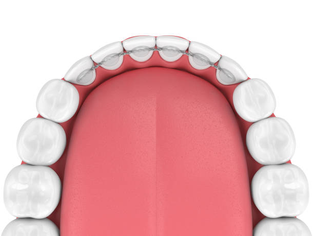 istock 3d render of dental bonded retainer on lower jaw 1204178866