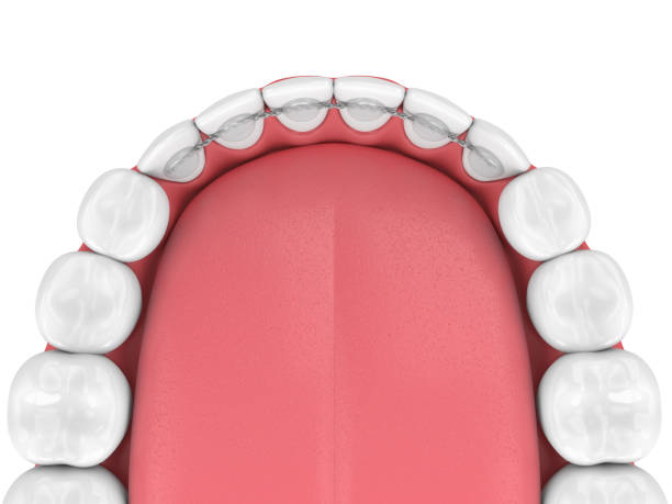 3d render of dental bonded retainer on lower jaw 3d render of dental bonded retainer on lower jaw over white background teeth bonding stock pictures, royalty-free photos & images