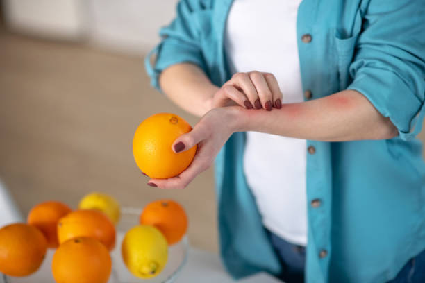 istock Woman having an urticaria because of oranges 1204267377