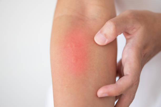 istock man itching and scratching on arm from itchy dry skin eczema dermatitis 1204304296