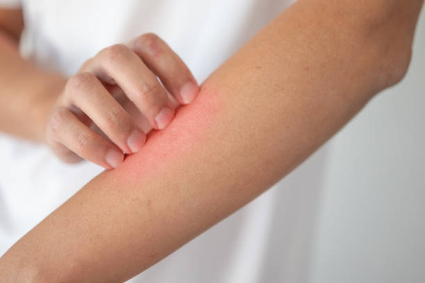 istock man itching and scratching on arm from itchy dry skin eczema dermatitis 1204304299