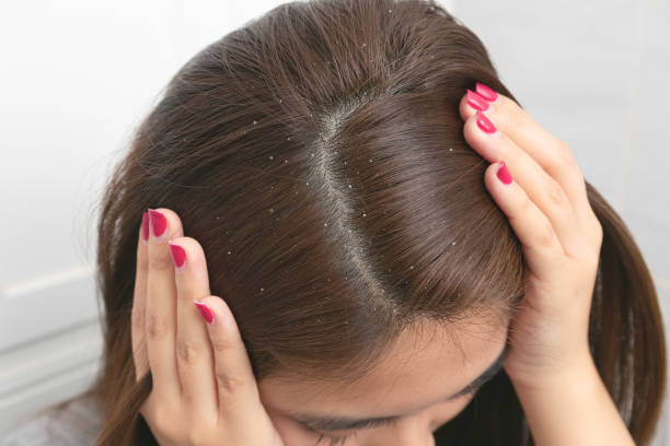 Close up hair at the dandruff on brown female hair. stock photo