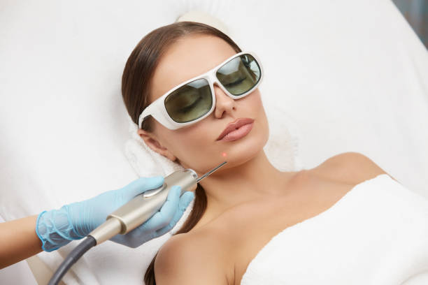 close-up of petty woman receiving laser procedures for her chin wearing protection glasses stock photo