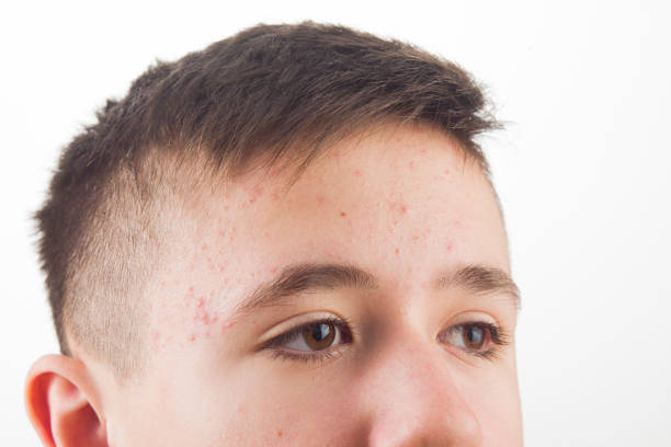 istock Acne, a problem in adolescent adolescents aged 13 years 1204411687