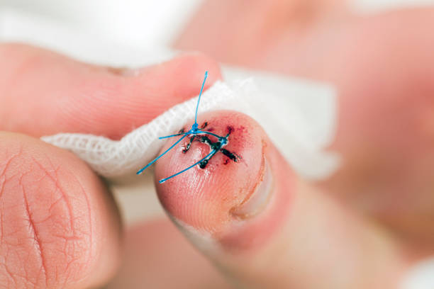 stapled deep cut on the finger - wound blood human finger human hand imagens e fotografias de stock