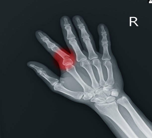 Navigular Hand Navicular Bone Of Hand Photos Stock Photos, Pictures & Royalty-Free ...