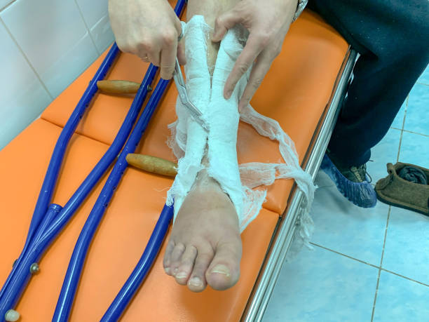 um jovem remove gesso na perna com uma tesoura em um hospital. muletas estão por perto - physical injury hospital cast doctor - fotografias e filmes do acervo