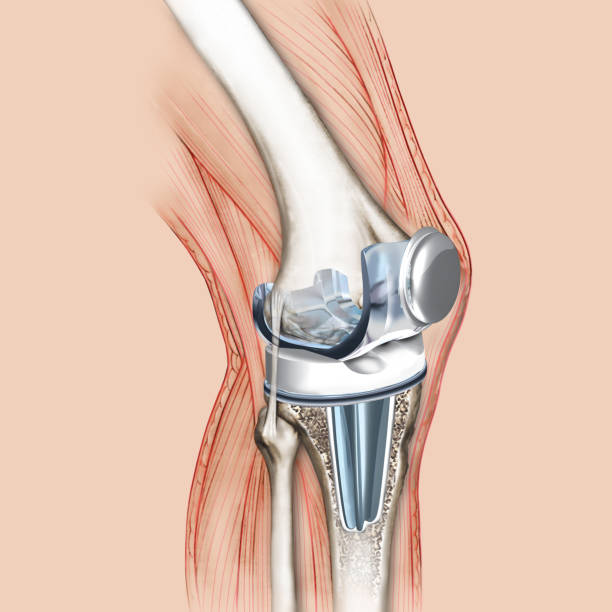 Knee prosthesis replaces the damaged kneecap joint The knee prosthesis replaces the damaged joint of the patella. Knee prosthesis is offered to patients who suffer from very advanced osteoarthritis. artificial knee photos stock pictures, royalty-free photos & images