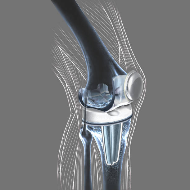 Knee prosthesis replaces the damaged kneecap joint The knee prosthesis replaces the damaged joint of the patella. Knee prosthesis is offered to patients who suffer from very advanced osteoarthritis. artificial knee photos stock pictures, royalty-free photos & images