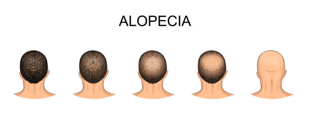ilustrações, clipart, desenhos animados e ícones de cabeça masculina, alopecia - alopecia antes depois